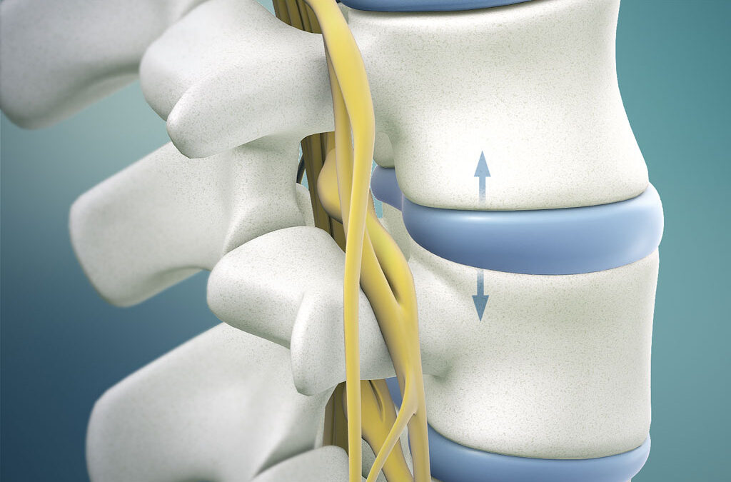 Conditions Treated by Spinal Decompression Therapy